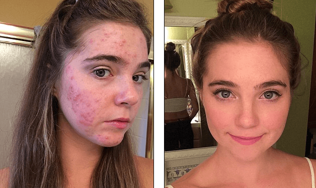 Twins Make Acne History By Adopting A Plant-Based Diet