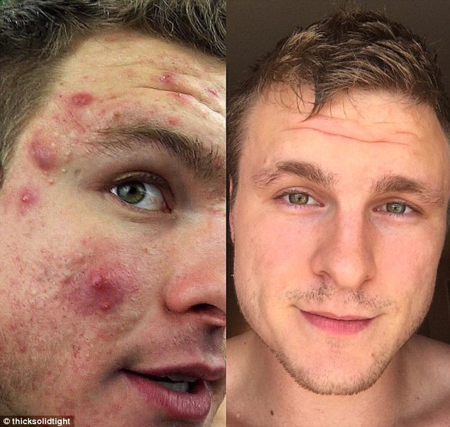 How This Man Converted Acne Into A CrystalClear Complexion by Going