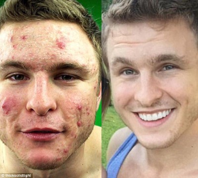 How This Man Converted Acne Into A Crystal-Clear Complexion by Going Vegan